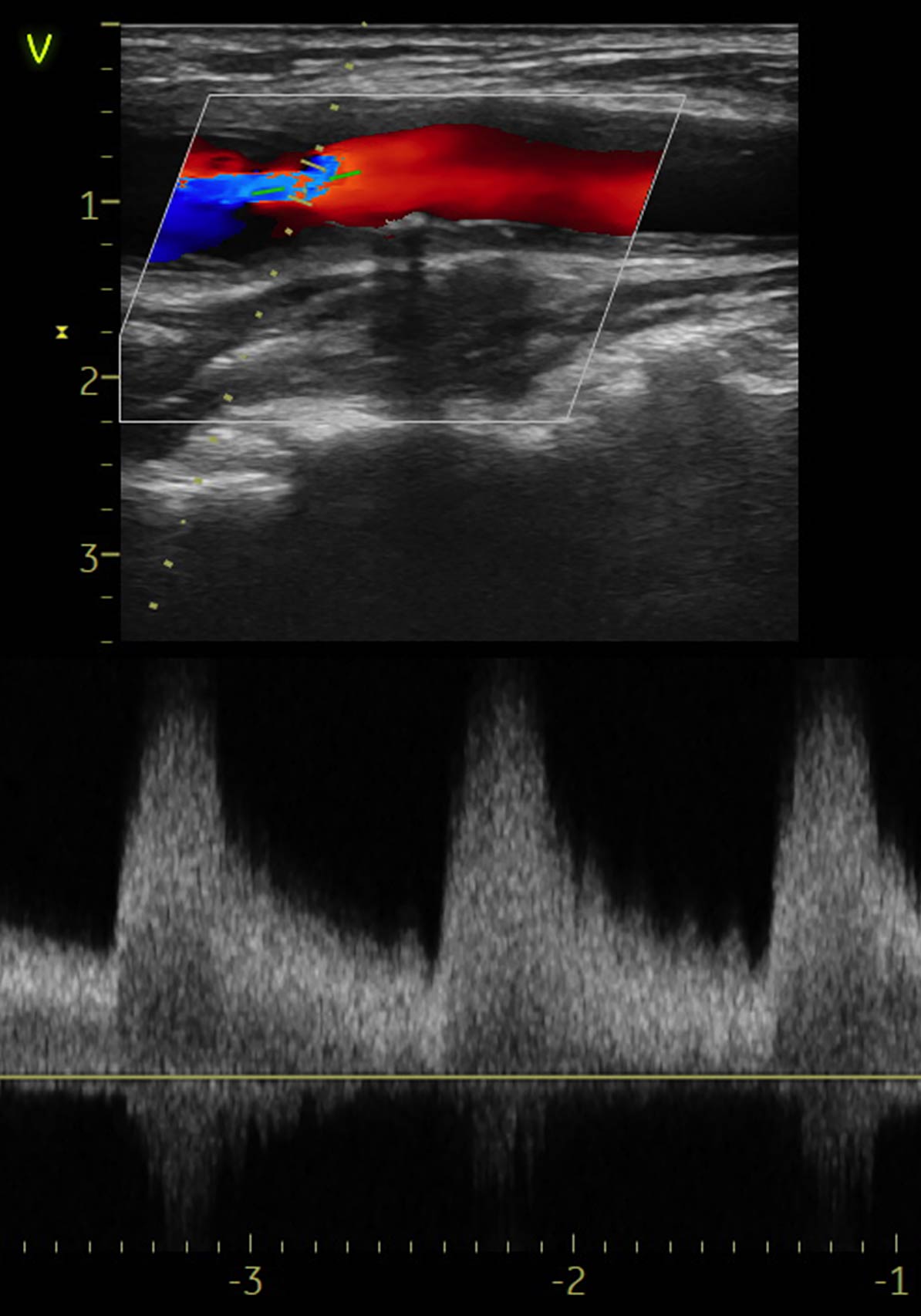 Ecografie vasculara carotidiana Doppler color